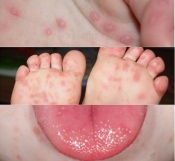 Bệnh Tay chân miệng Bệnh Tay chân miệng