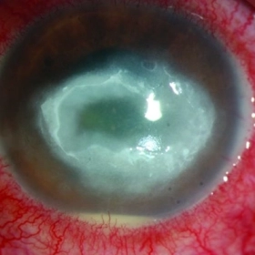 Viêm Giác Mạc Do Acanthamoeba: Nhiễm Trùng Mắt Hiếm Gặp Nhưng Nguy Hiểm