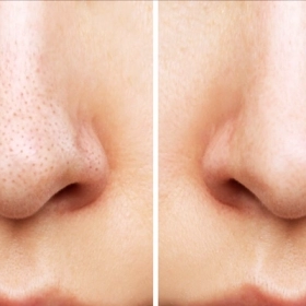 10 Cách Thu Nhỏ Lỗ Chân Lông Tự Nhiên An Toàn, Tiết Kiệm