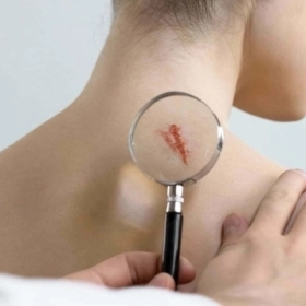 10 Mẹo Chữa Sẹo Lồi Dân Gian Hiệu Quả Ngay Tại Nhà