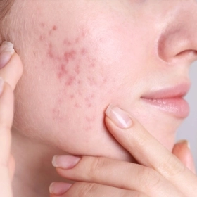 7 Cách Trị Thâm Mụn Nhanh Nhất Tại Nhà Bằng Nguyên Liệu Tự Nhiên