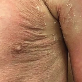  Á Sừng: Nguyên Nhân, Triệu Chứng và Cách Điều Trị Hiệu Quả