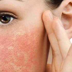 Bà Bầu Dị Ứng Mỹ Phẩm Phải Làm Gì? Cách Xử Lý An Và Phòng Ngừa