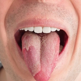 Bạch Sản Là Gì? Nguyên Nhân, Triệu Chứng Và Cách Điều Trị