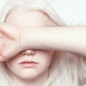 Bạch tạng: Nguyên nhân, phân loại và cách chăm sóc sức khỏe