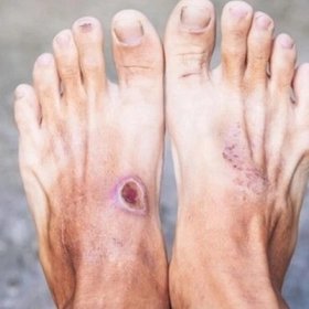 Bàn Chân Tiểu Đường: Dấu Hiệu Nhận Biết, Nguy Cơ Và Cách Chăm Sóc