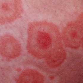 Bệnh Á Vảy Nến Là Gì? Triệu Chứng, Cách Điều Trị Hiệu Quả