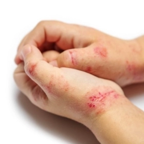 Bệnh Chốc Lở: Nguyên Nhân, Triệu Chứng và Cách Điều Trị 