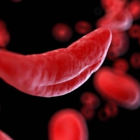 Bệnh Hồng Cầu Hình Liềm: Nguyên Nhân, Triệu Chứng Và Cách Điều Trị