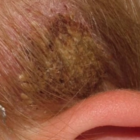 Bệnh Kerion: Nguyên Nhân, Triệu Chứng Và Cách Điều Trị