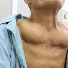 Bệnh Madelung: Nguyên nhân, triệu chứng và hướng điều trị