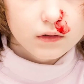 Bệnh Máu Khó Đông Là Đột Biến Gì? Nguyên Nhân Và Giải Pháp Điều Trị