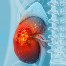 Bệnh nang tủy thận: Nguyên nhân và cách quản lý chức năng thận