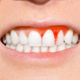 Bệnh Scorbut Là Gì? Nguyên Nhân, Dấu Hiệu Và Cách Điều Trị Hiệu Quả