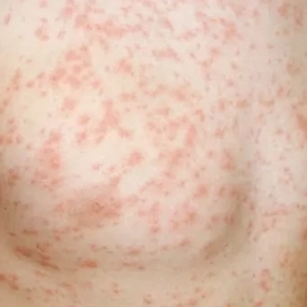 Bệnh Still: Dấu Hiệu, Nguyên Nhân Và Các Phương Pháp Điều Trị