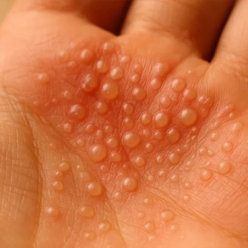 Bệnh Tổ Đỉa Bao Lâu Thì Khỏi? Giải Đáp Chi Tiết 