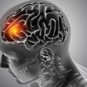 Bệnh U Não Sống Được Bao Lâu? Tiên Lượng, Dấu Hiệu Và Hướng Điều Trị