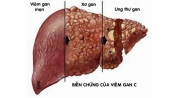 Bệnh viêm gan C Bệnh viêm gan C