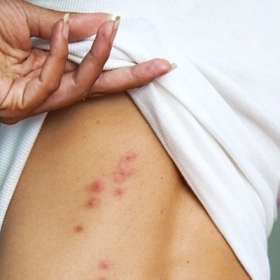 Bị Dị Ứng Ngứa Khắp Người Phải Làm Sao? Cách Xử Lý Nhanh Tại Nhà