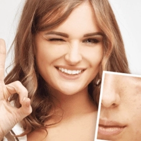 Bị Mụn Nội Tiết Nên Uống Vitamin Gì? Gợi Ý Từ Chuyên Gia Da Liễu