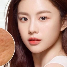 Bí Quyết Lựa Chọn Kem Trị Sẹo Rỗ Phù Hợp Với Tình Trạng Da