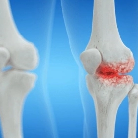 Bị Thoái Hóa Khớp Gối Nên Tập Gì? 10 Bài Tập Phục Hồi Tại Nhà