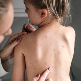 Bị Thủy Đậu Kiêng Gì Để Không Bị Sẹo? Bí Quyết Ăn Uống Và Chăm Sóc Da