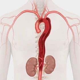 Bóc Tách Động Mạch Chủ: Nguyên Nhân, Triệu Chứng Và Cách Điều Trị Hiệu Quả