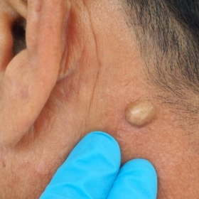 Bướu bã đậu: Nguyên nhân, triệu chứng và phương pháp điều trị