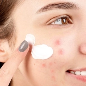 Cách Chọn Kem Chống Nắng Cho Da Dầu Mụn Hiệu Quả