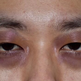 Cách Làm Tan Vết Bầm Tím Ở Mắt Nhanh Nhất, An Toàn Và Hiệu Quả