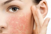 Bật mí: 5 cách trị dị ứng da mặt tại nhà đơn giản
