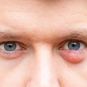 Cách Trị Mụn Lẹo Dân Gian Bằng Chỉ Có Thật Sự Hiệu Quả?