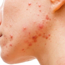 Cách Trị Mụn Nội Tiết Sau Sinh An Toàn Cho Mẹ Bỉm Hiệu Quả Nhất