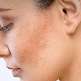 Cách Trị Nám Gò Má Tại Nhà Hiệu Quả Bằng Nguyên Liệu Tự Nhiên