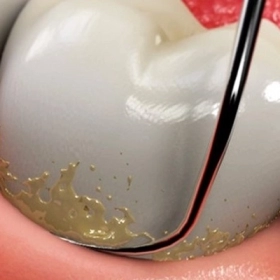 Cao Răng Là Gì? Nguyên Nhân, Tác Hại Và Cách Loại Bỏ Hiệu Quả
