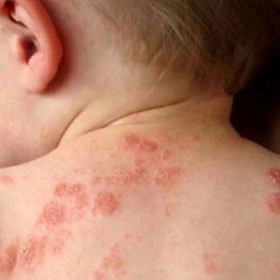 Chàm Da Là Gì? Dấu Hiệu Nhận Biết Và Biện Pháp Phòng Ngừa