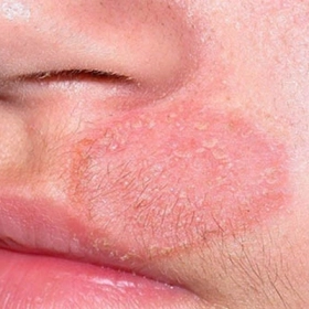 Chàm đồng tiền: Nguyên nhân, dấu hiệu và phác đồ điều trị hiệu quả