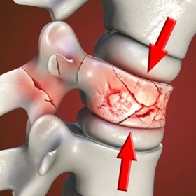 Chấn Thương Cột Sống: Triệu Chứng, Sơ Cứu Và Cách Điều Trị