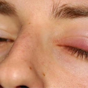 Chắp Mắt Phải Làm Sao? 7 Cách Xử Lý Hiệu Quả Tại Nhà