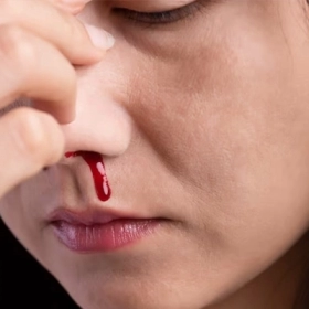 Chảy Máu Cam Nên Làm Gì Và Không Nên Làm Gì?