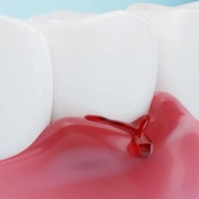 Chảy Máu Chân Răng Có Phải Dấu Hiệu Ung Thư Không?