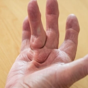 Co Rút Dupuytren: Dấu Hiệu, Nguyên Nhân Và Cách ĐiềuTrị