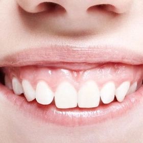 Cười Hở Lợi Là Gì? Nguyên Nhân, Dấu Hiệu Và Cách Điều Trị