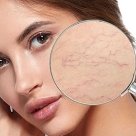 Da Bị Mỏng Phải Làm Sao? Cách Phục Hồi Da Khỏe Từ Bên Trong