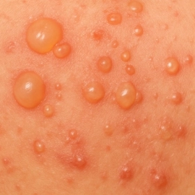 Da Bọng Nước Tự Miễn Pemphigus: Nguyên Nhân, Triệu Chứng và Điều Trị