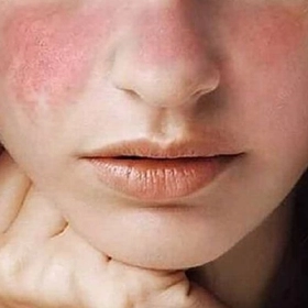 Da Mặt Bị Dị Ứng Nổi Sần Ngứa Là Do Đâu? Cách Xử Lý Hiệu Quả