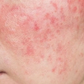 Da Mặt Bị Nhiễm Corticoid Phải Làm Sao? Cách Hồi Phục Da An Toàn