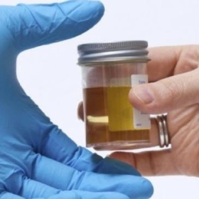 Đạm niệu là gì? Nguyên nhân, dấu hiệu và cách điều trị