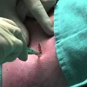 Dẫn Lưu Màng Phổi Là Gì? Quy Trình, Chỉ Định Và Lưu Ý